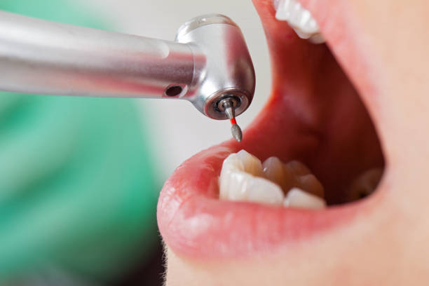 Best Emergency Tooth Extraction in Belhaven, NC